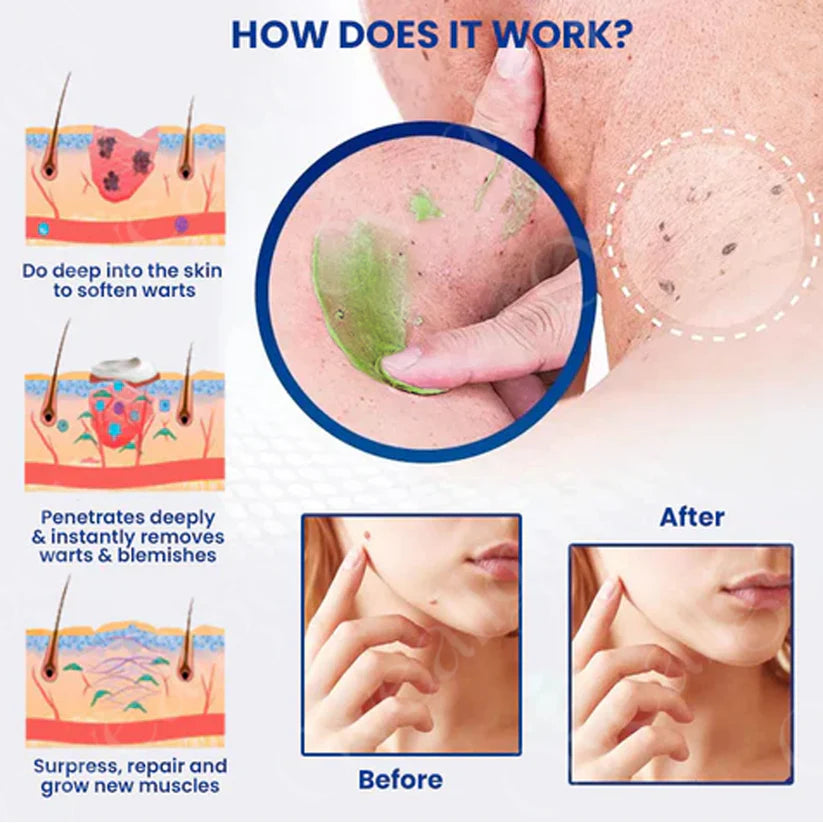Femica™ NatureErase Instant Mole & Spot Cream